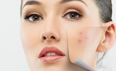 adult-acne-can-be-treated-jpg-nggid03114-ngg0dyn-0x0x100-00f0w010c010r110f110r010t010