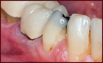 آشنایی با 4 عامل پوسیدگی دندان 